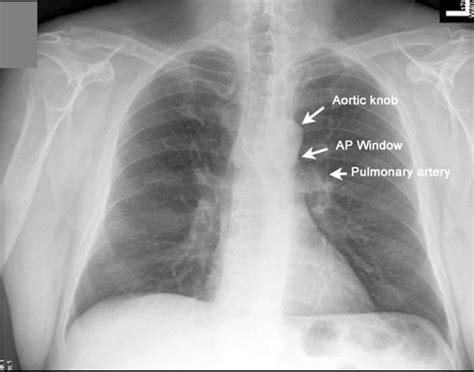 plain ap|ap window boundary.